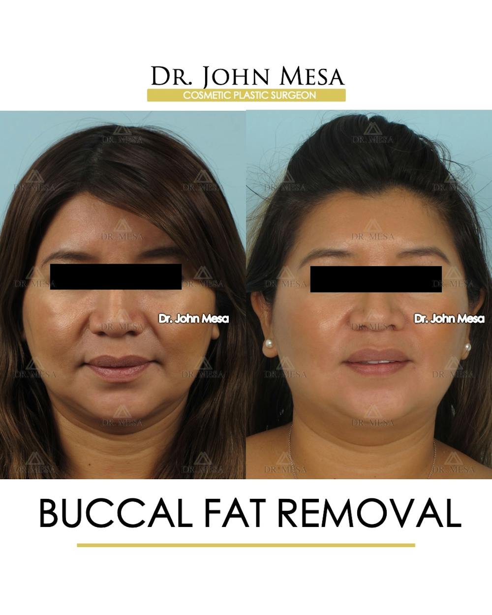 Buccal Fat Pad Removal Before & After Gallery - Patient 206282 - Image 1