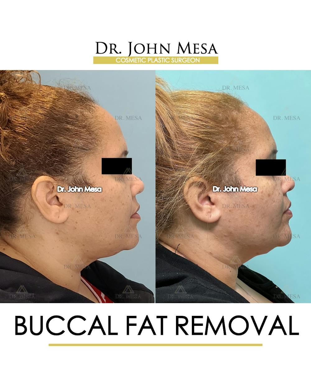 Buccal Fat Pad Removal Before & After Gallery - Patient 393589 - Image 3