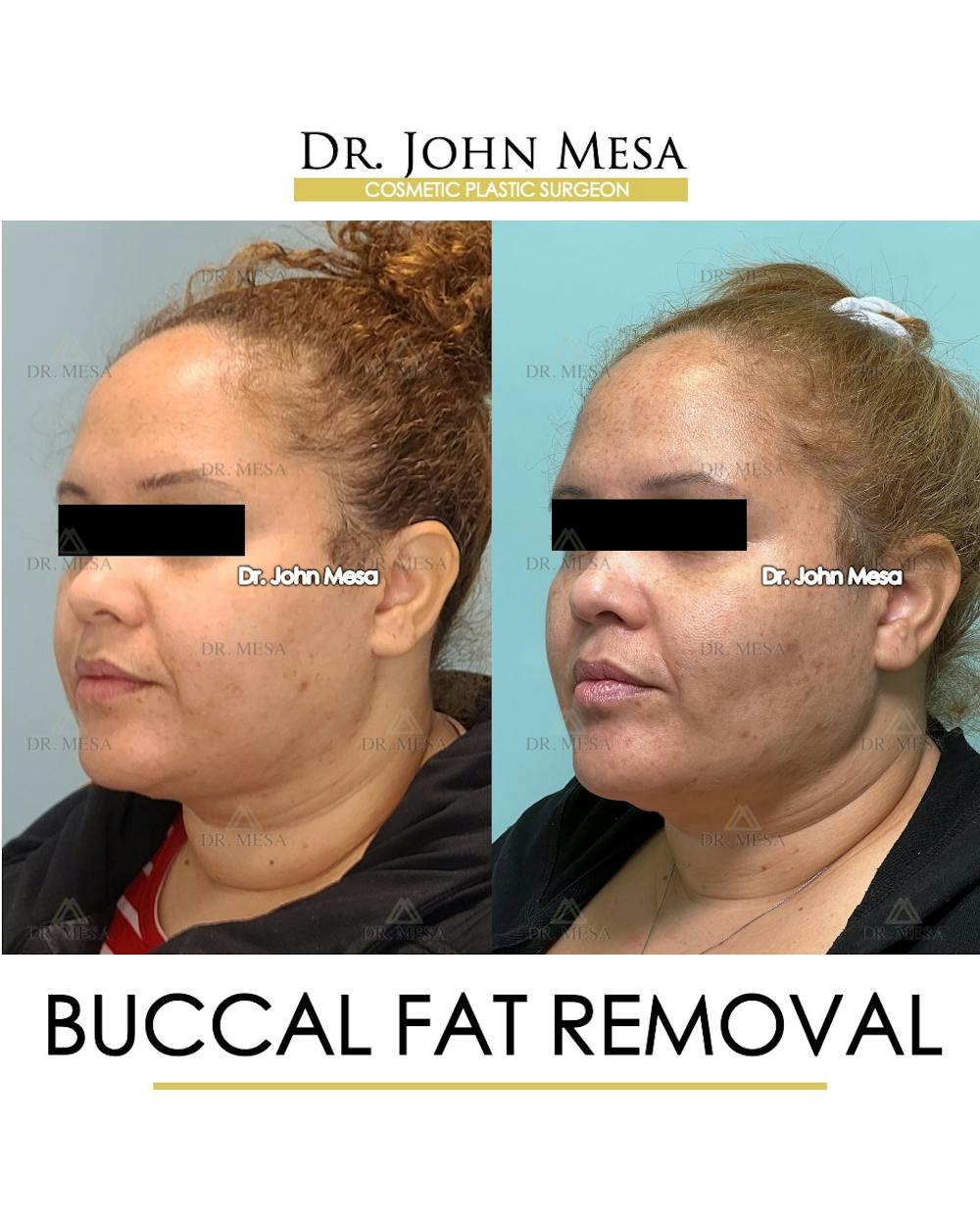 Buccal Fat Pad Removal Before & After Gallery - Patient 393589 - Image 4