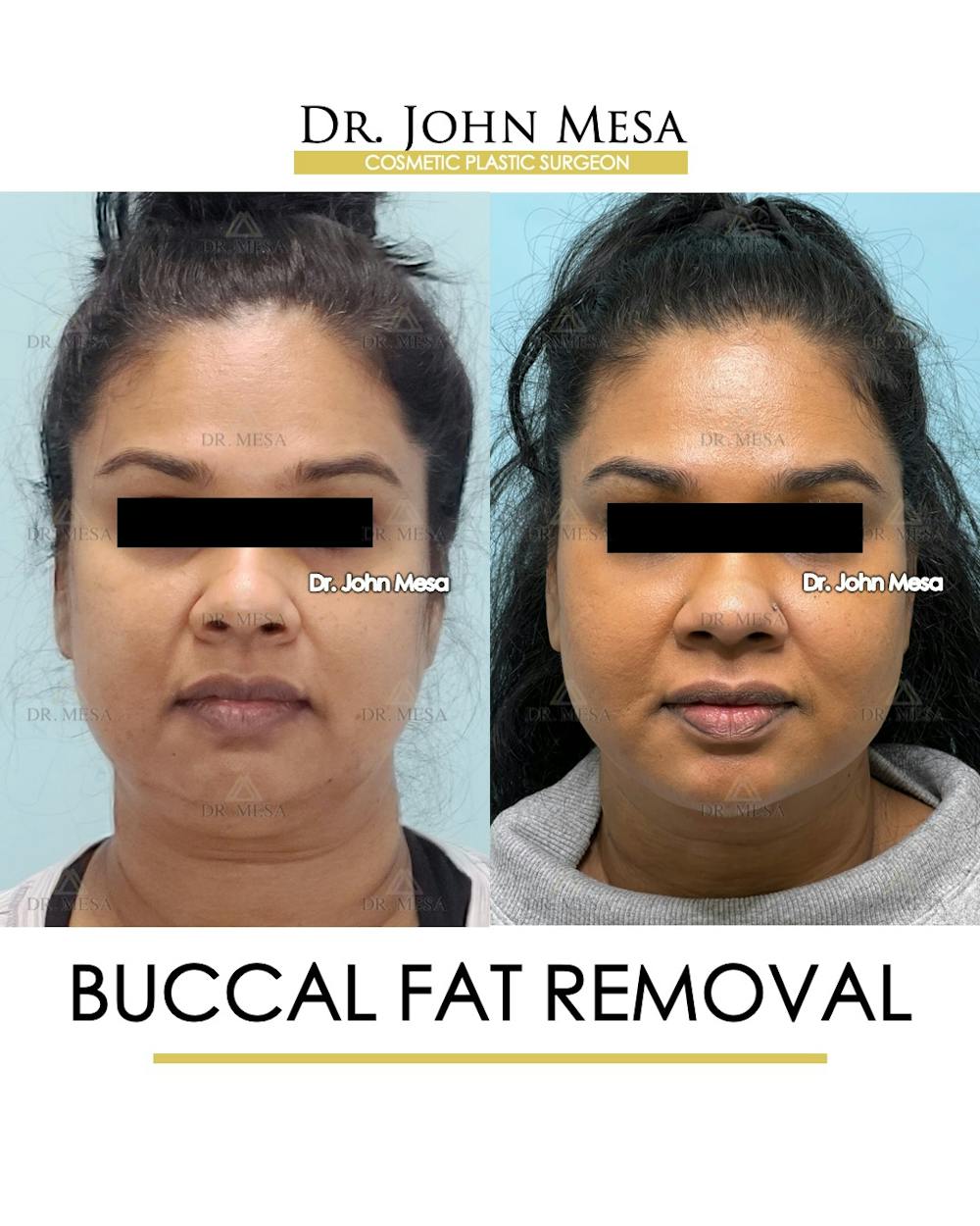 Buccal Fat Pad Removal Before & After Gallery - Patient 142715 - Image 1