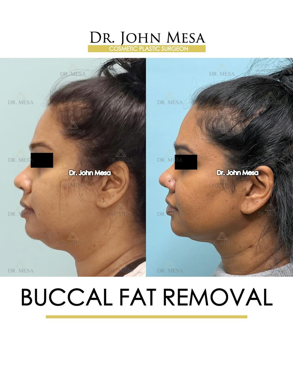 Buccal Fat Pad Removal Before & After Gallery - Patient 142715 - Image 5
