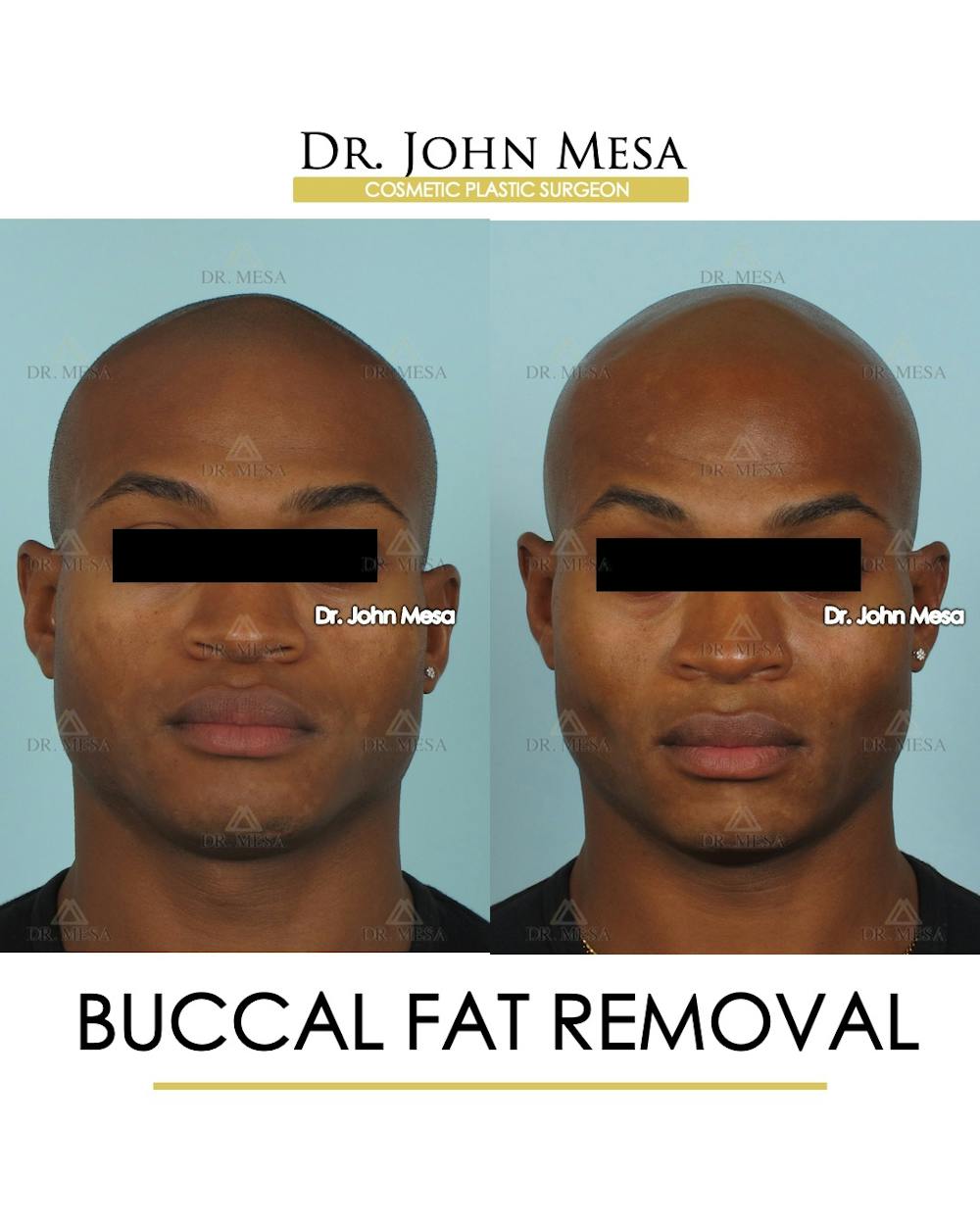 Buccal Fat Pad Removal for Men Before & After Gallery - Patient 807049 - Image 1