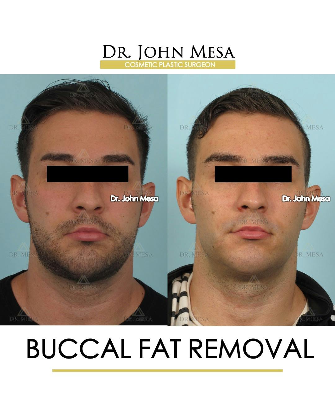 Buccal Fat Pad Removal for Men Before & After Gallery - Patient 380225 - Image 1