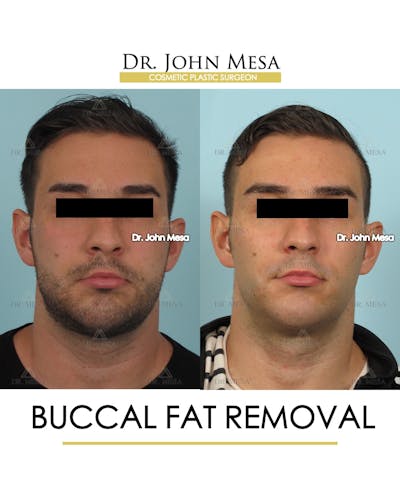 Buccal Fat Pad Removal for Men Before & After Gallery - Patient 380225 - Image 1