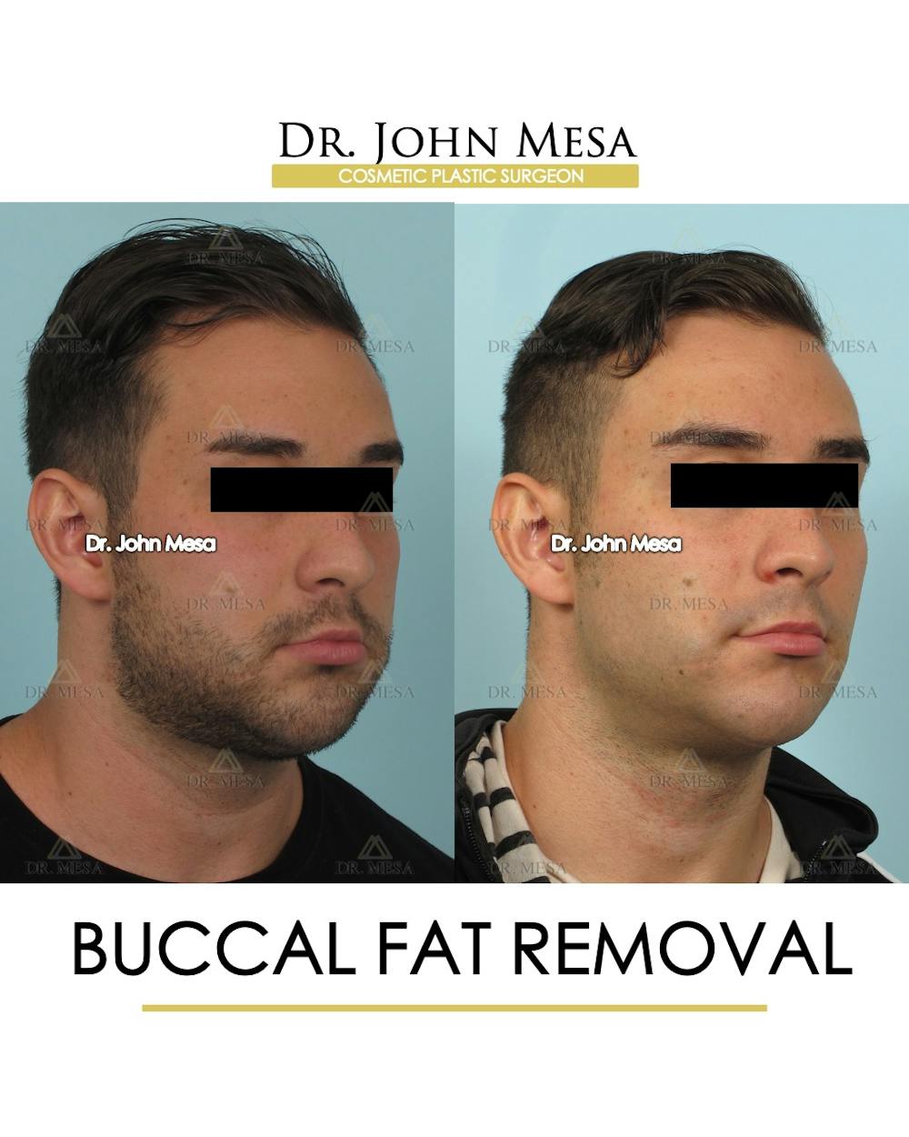 Buccal Fat Pad Removal for Men Before & After Gallery - Patient 380225 - Image 2