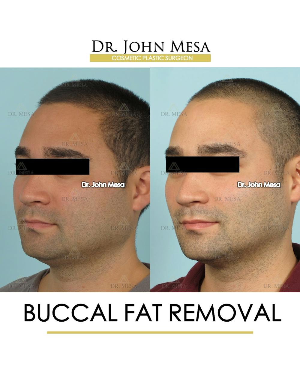 Buccal Fat Pad Removal for Men Before & After Gallery - Patient 168195 - Image 3