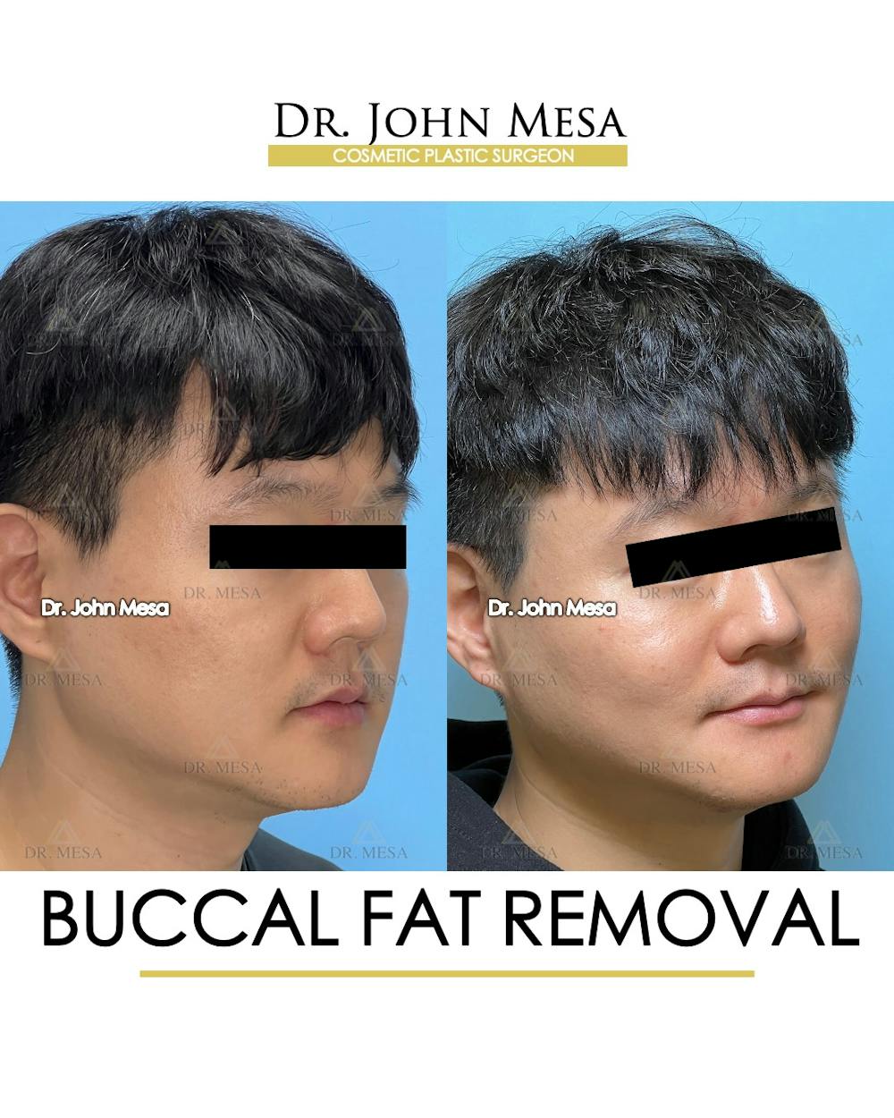 Buccal Fat Pad Removal for Men Before & After Gallery - Patient 401938 - Image 3