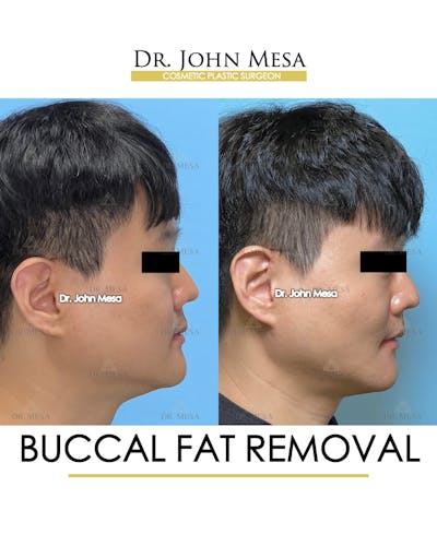 Buccal Fat Pad Removal for Men Before & After Gallery - Patient 401938 - Image 4