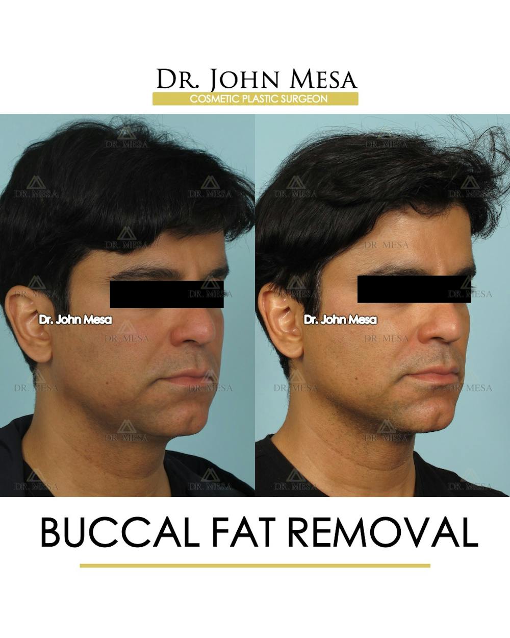 Buccal Fat Pad Removal for Men Before & After Gallery - Patient 335070 - Image 3