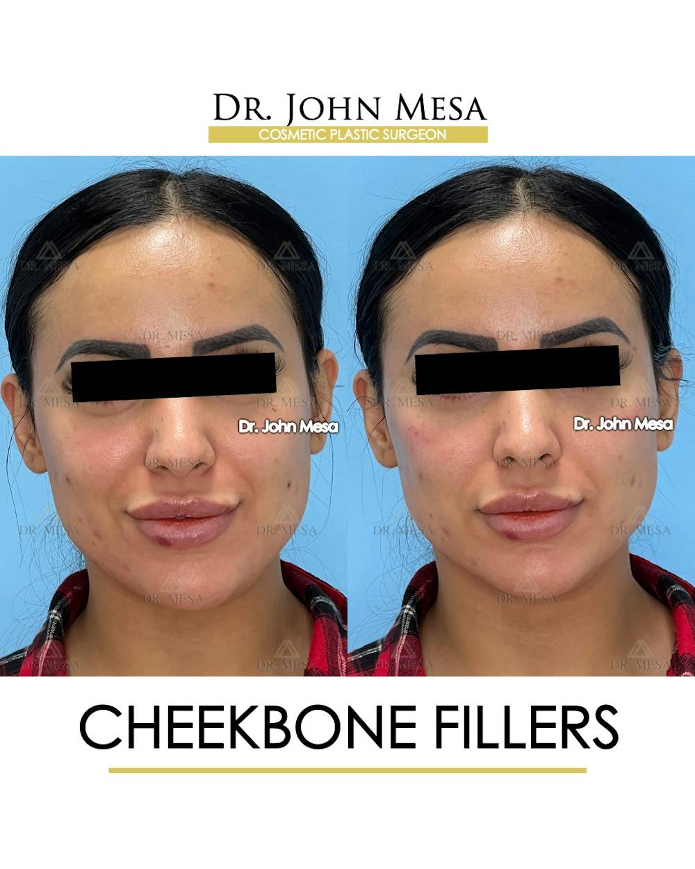 Cheekbone Filler Before & After Gallery - Patient 143289 - Image 1