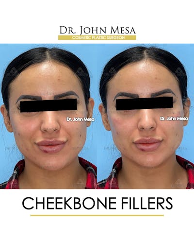 Cheekbone Filler Before & After Gallery - Patient 143289 - Image 1