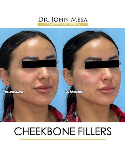 Cheekbone Filler Before & After Gallery - Patient 143289 - Image 2