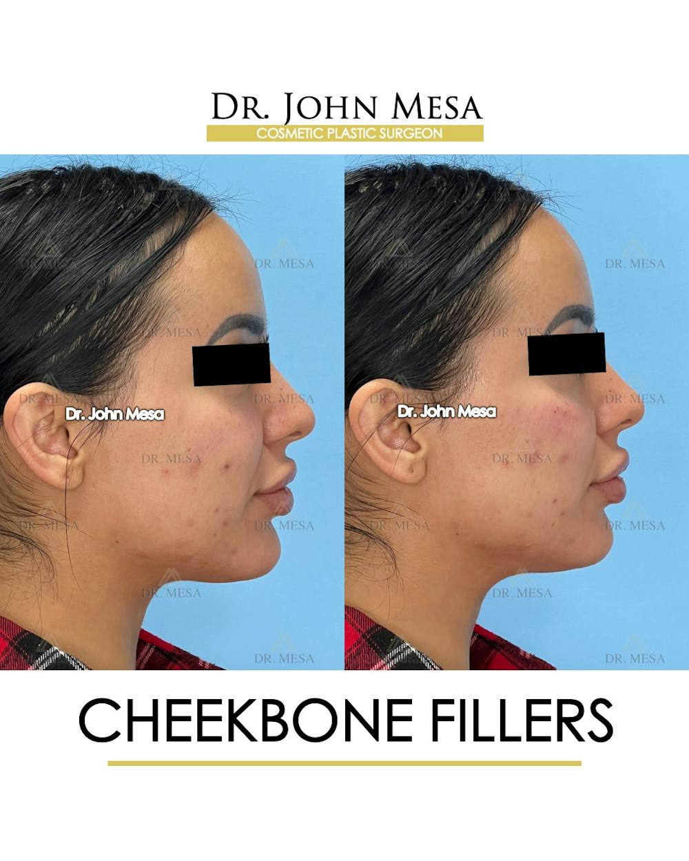 Cheekbone Filler Before & After Gallery - Patient 143289 - Image 3