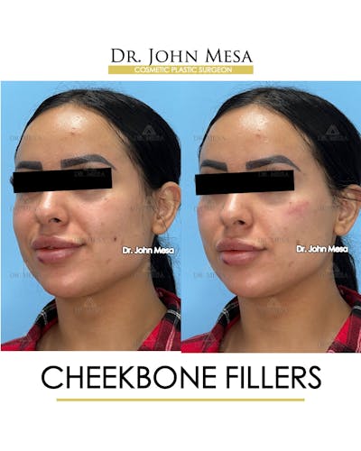 Cheekbone Filler Before & After Gallery - Patient 143289 - Image 4