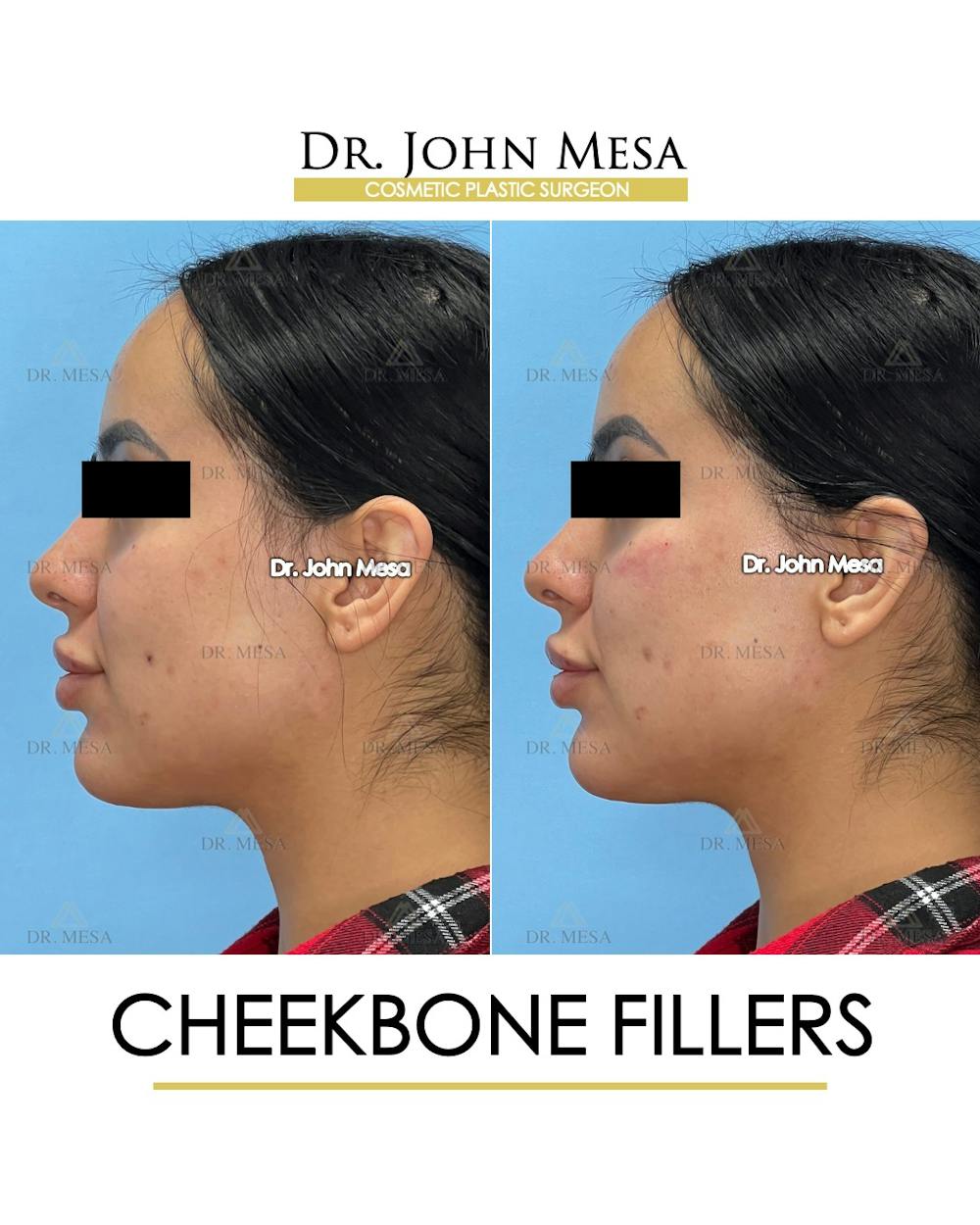 Cheekbone Filler Before & After Gallery - Patient 143289 - Image 5