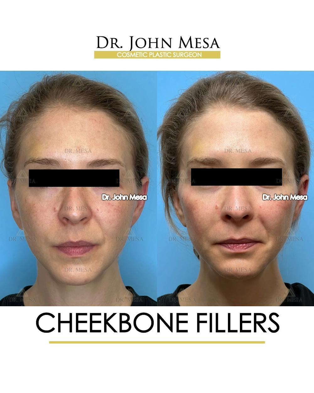 Cheekbone Filler Before & After Gallery - Patient 173164 - Image 1