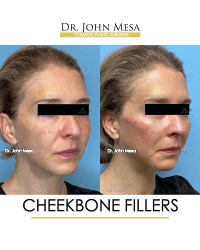 Cheekbone Filler Before & After Gallery - Patient 173164 - Image 2