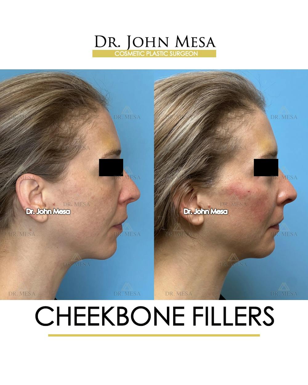 Cheekbone Filler Before & After Gallery - Patient 173164 - Image 3