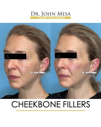 Cheekbone Filler Before & After Gallery - Patient 173164 - Image 4