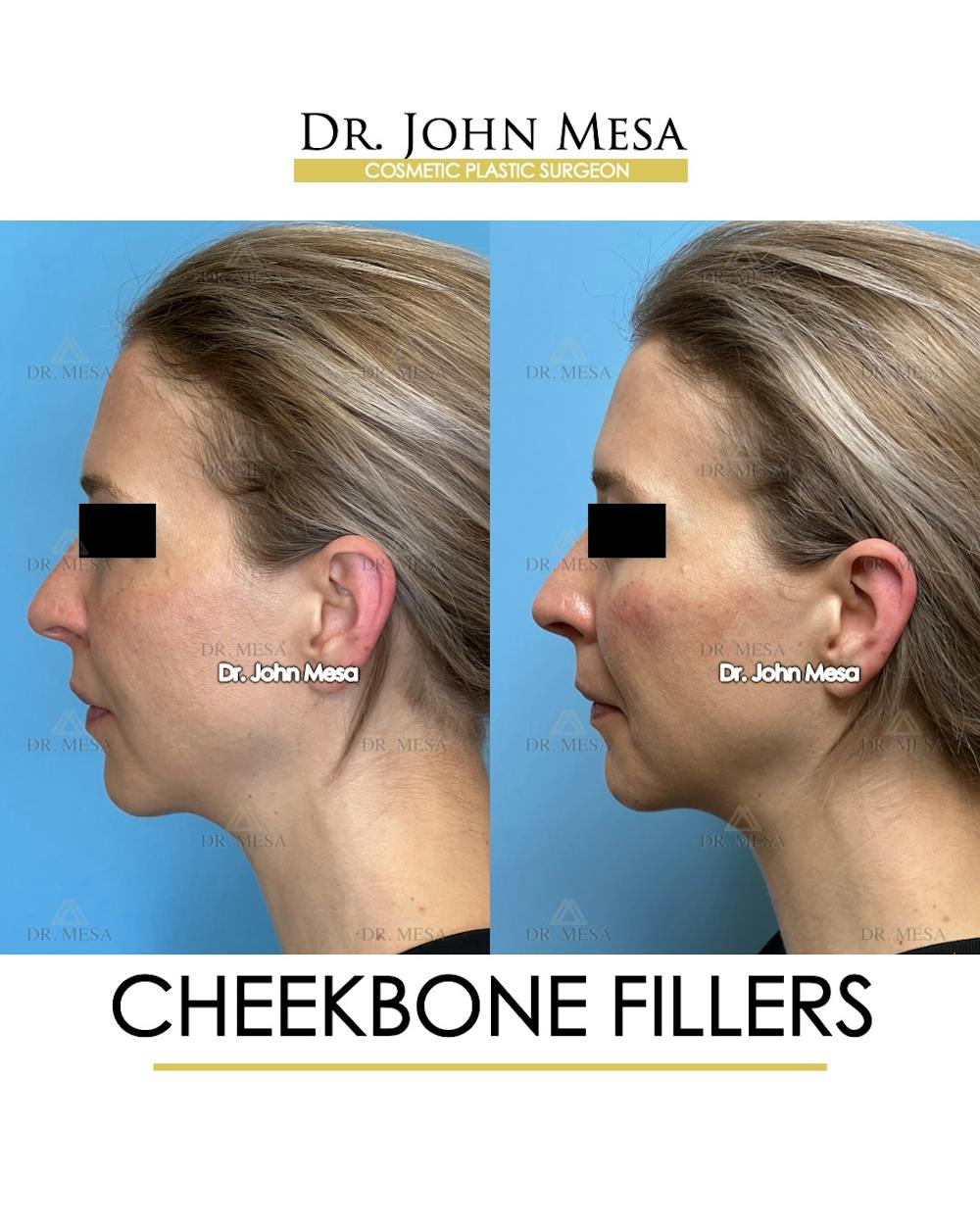Cheekbone Filler Before & After Gallery - Patient 173164 - Image 5