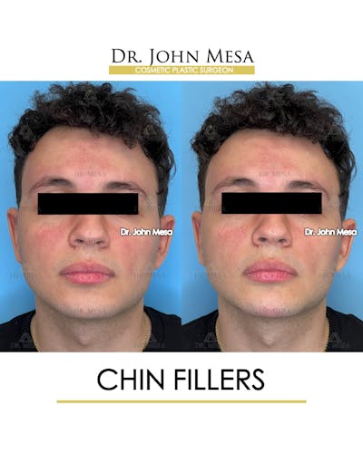 Chin Filler Before & After Gallery - Patient 170936 - Image 1
