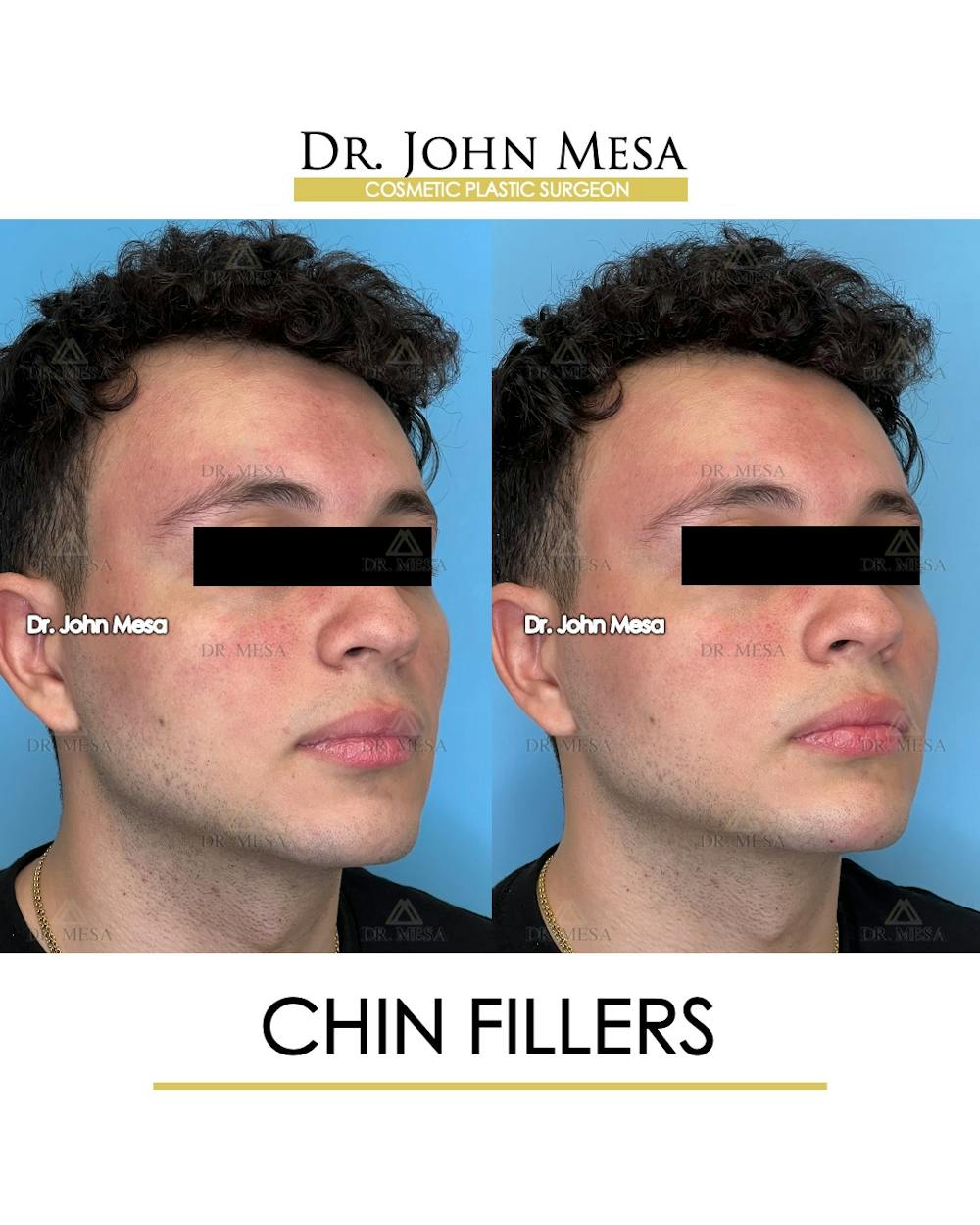 Chin Filler Before & After Gallery - Patient 170936 - Image 2