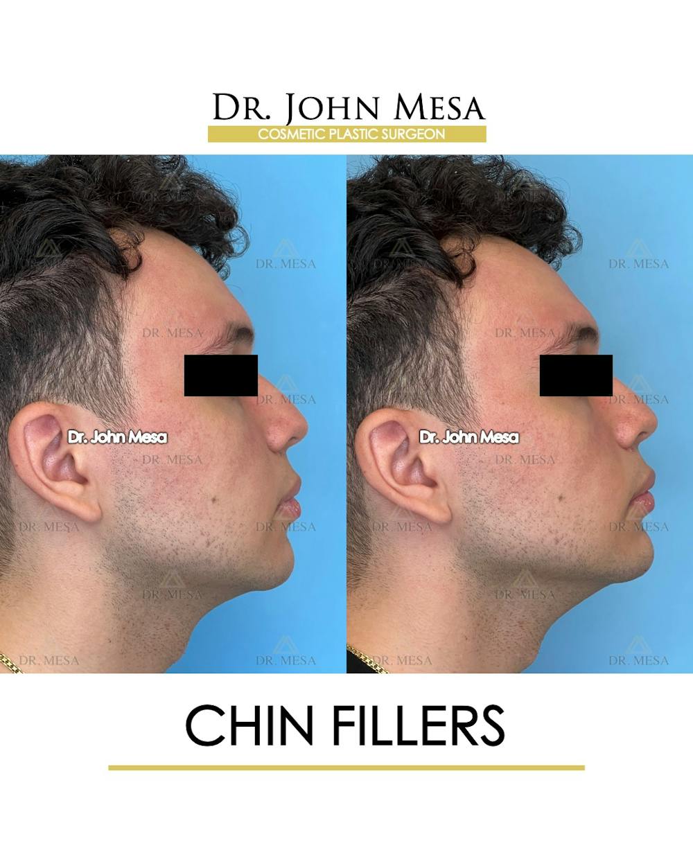 Chin Filler Before & After Gallery - Patient 170936 - Image 3