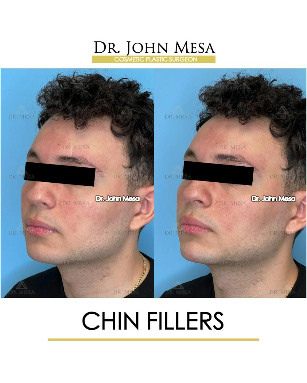 Chin Filler Before & After Gallery - Patient 170936 - Image 4