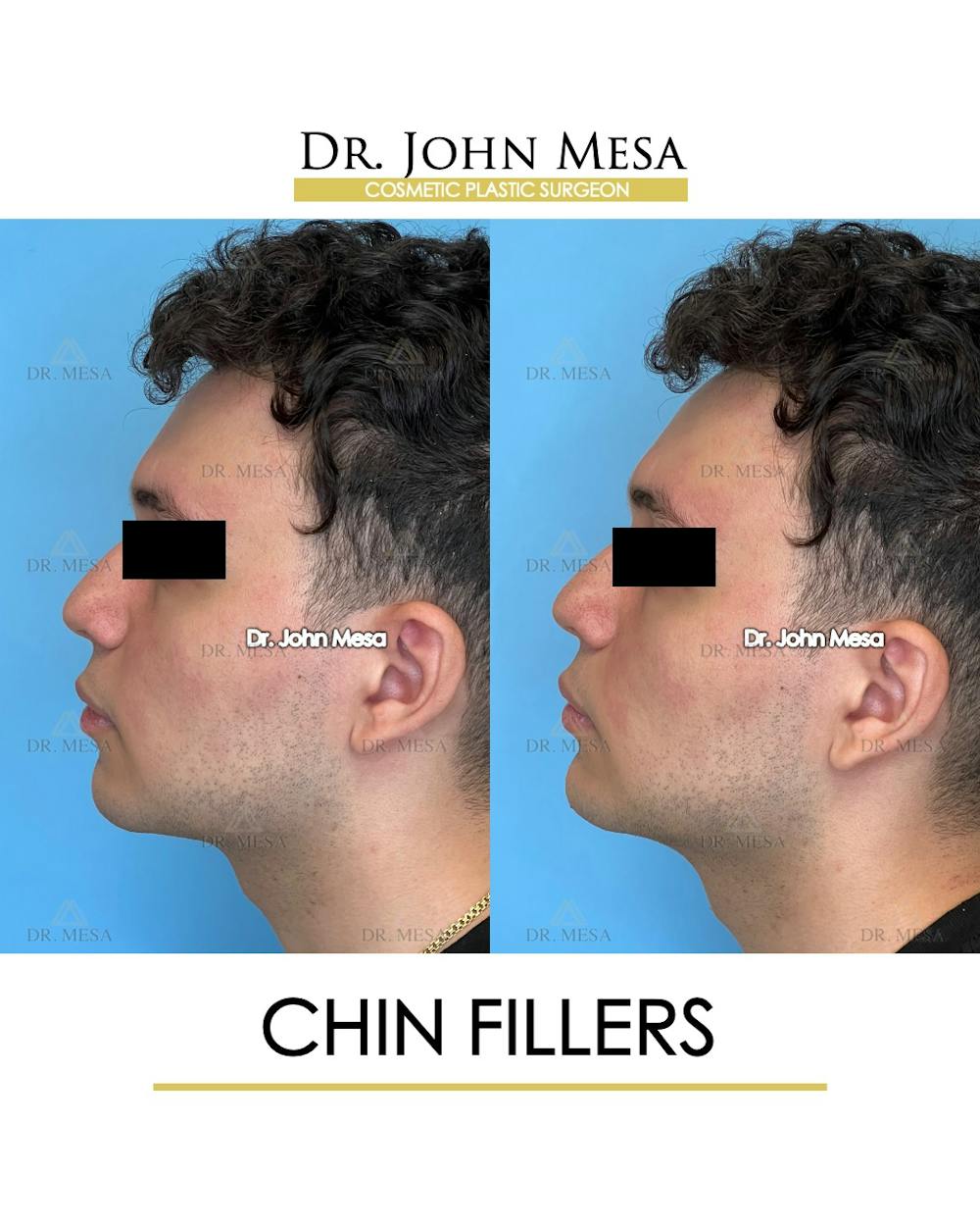 Chin Filler Before & After Gallery - Patient 170936 - Image 5