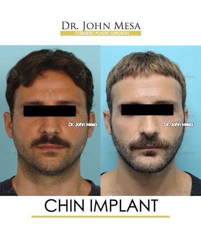 Chin Implant Before & After Gallery - Patient 848659 - Image 1