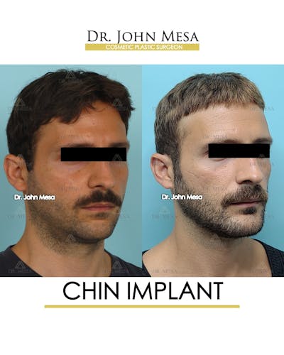 Chin Implant Before & After Gallery - Patient 848659 - Image 2