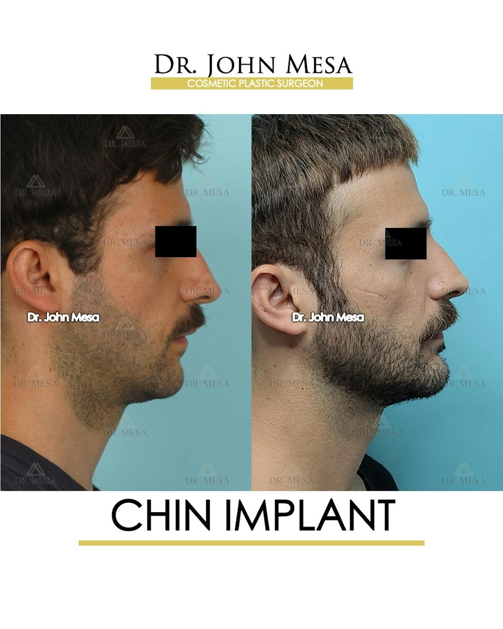 Chin Implant Before & After Gallery - Patient 848659 - Image 3