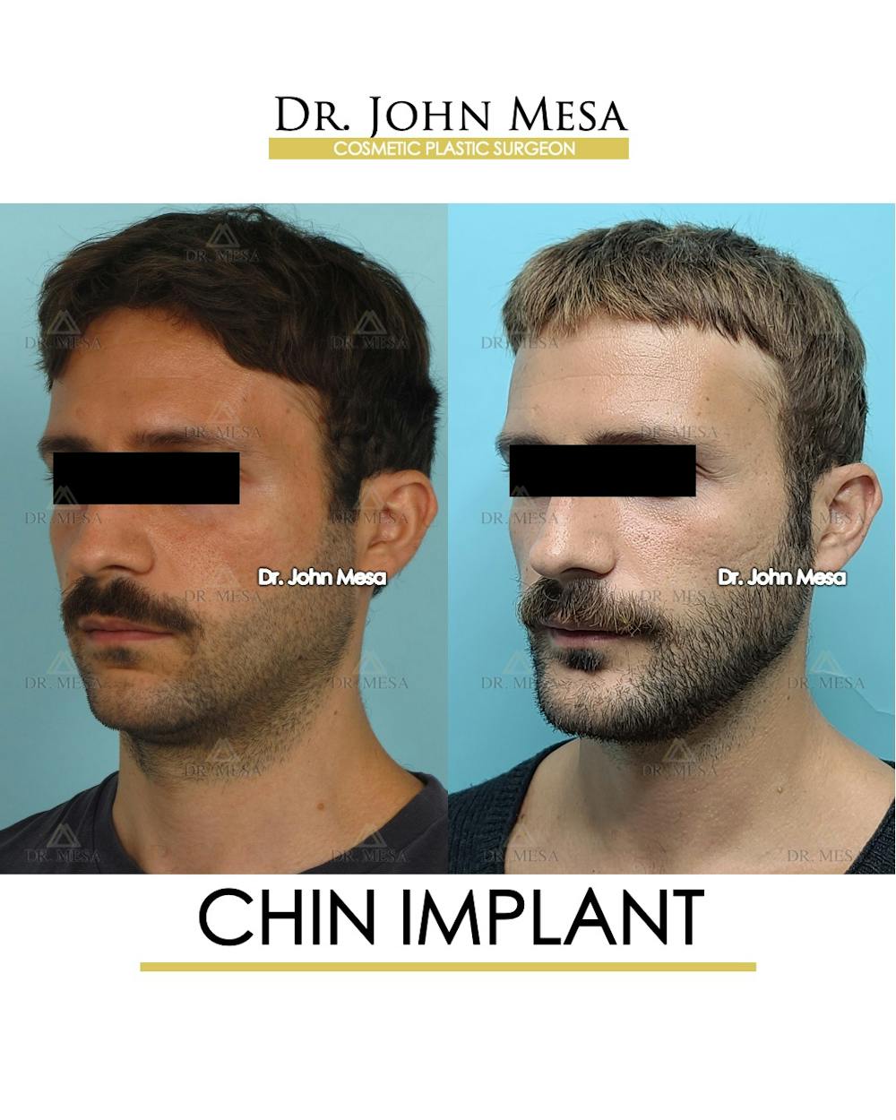 Chin Implant Before & After Gallery - Patient 848659 - Image 4