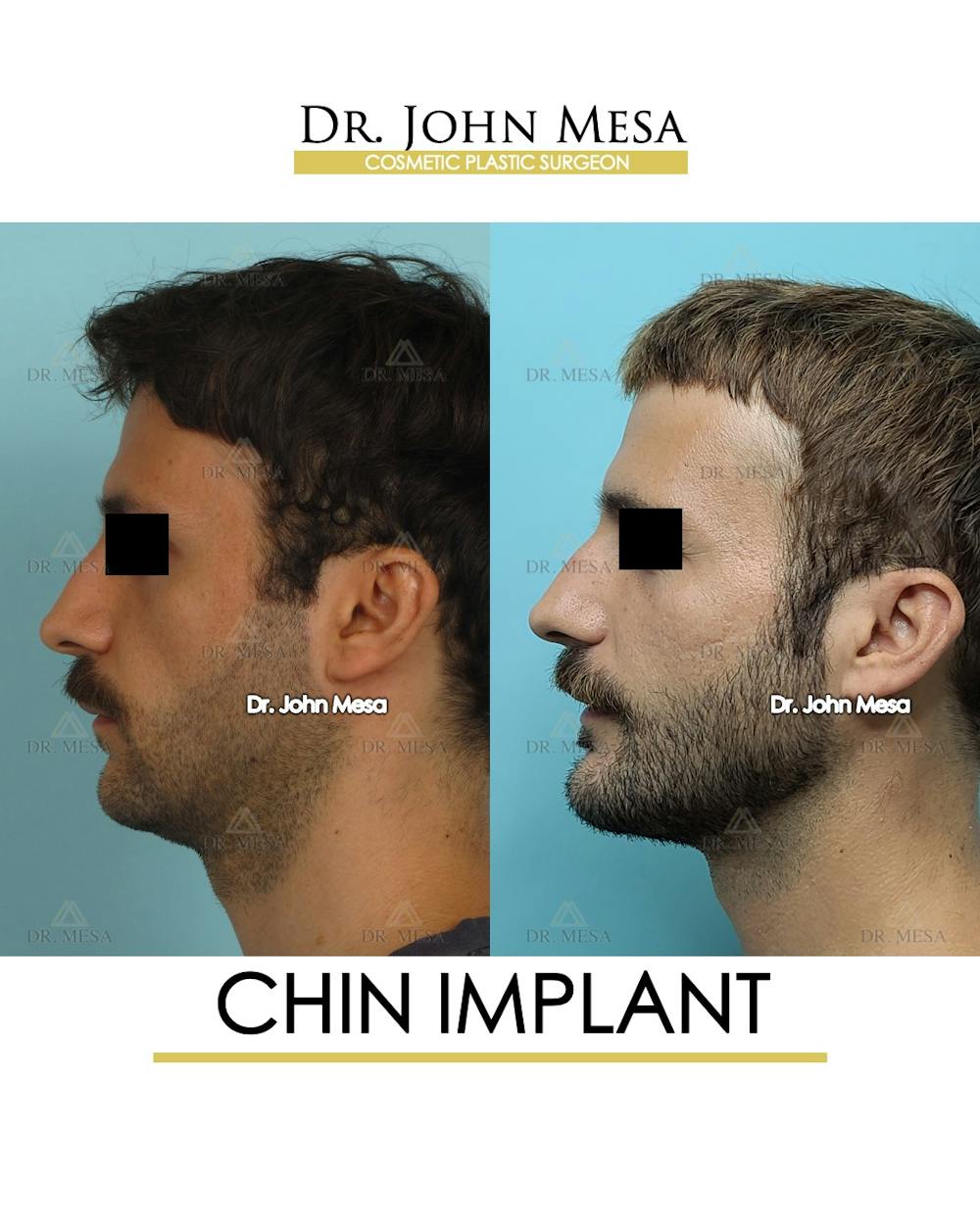 Chin Implant Before & After Gallery - Patient 848659 - Image 5