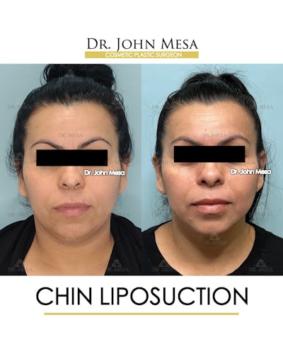 Chin Liposuction Before & After Gallery - Patient 413127 - Image 2