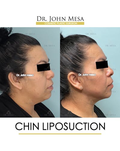 Chin Liposuction Before & After Gallery - Patient 413127 - Image 1