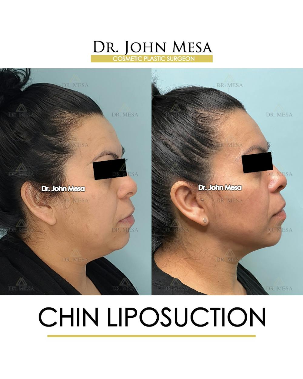 Chin Liposuction Before & After Gallery - Patient 413127 - Image 3