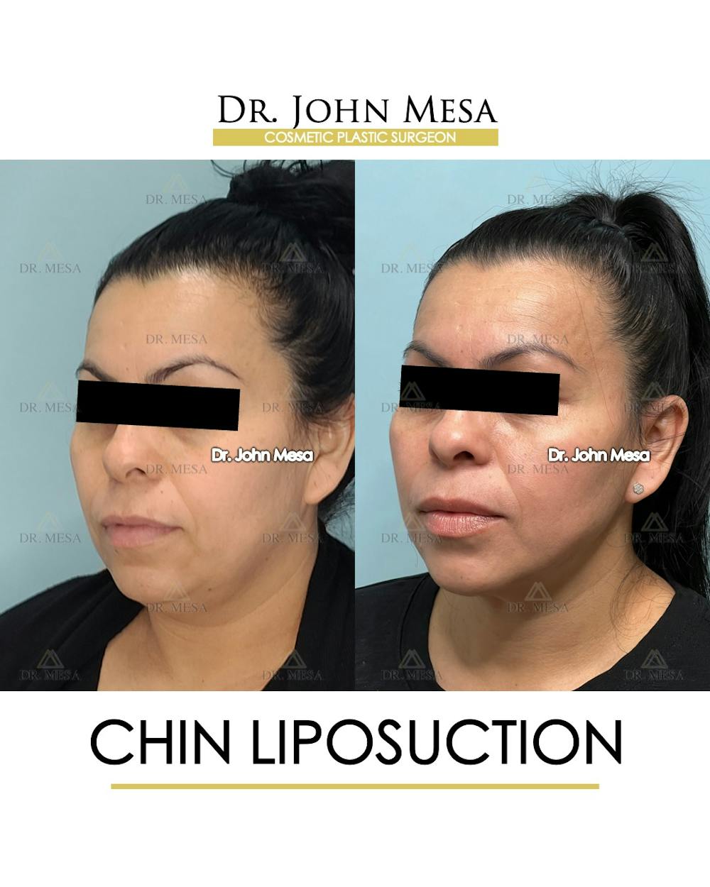 Chin Liposuction Before & After Gallery - Patient 413127 - Image 4