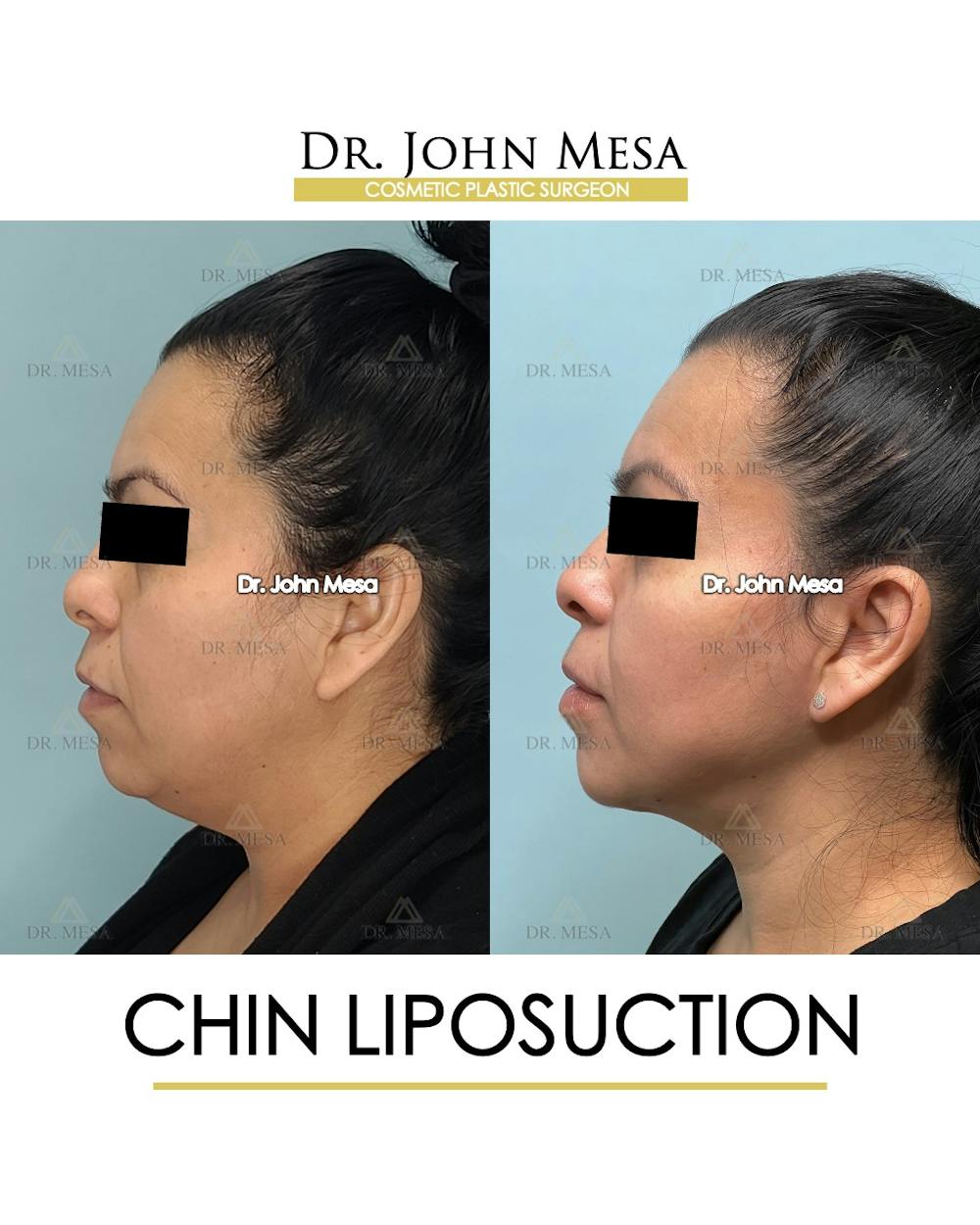 Chin Liposuction Before & After Gallery - Patient 413127 - Image 5