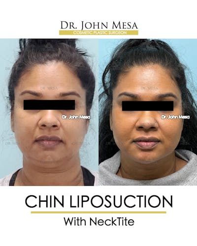 Chin Liposuction Before & After Gallery - Patient 100188 - Image 2