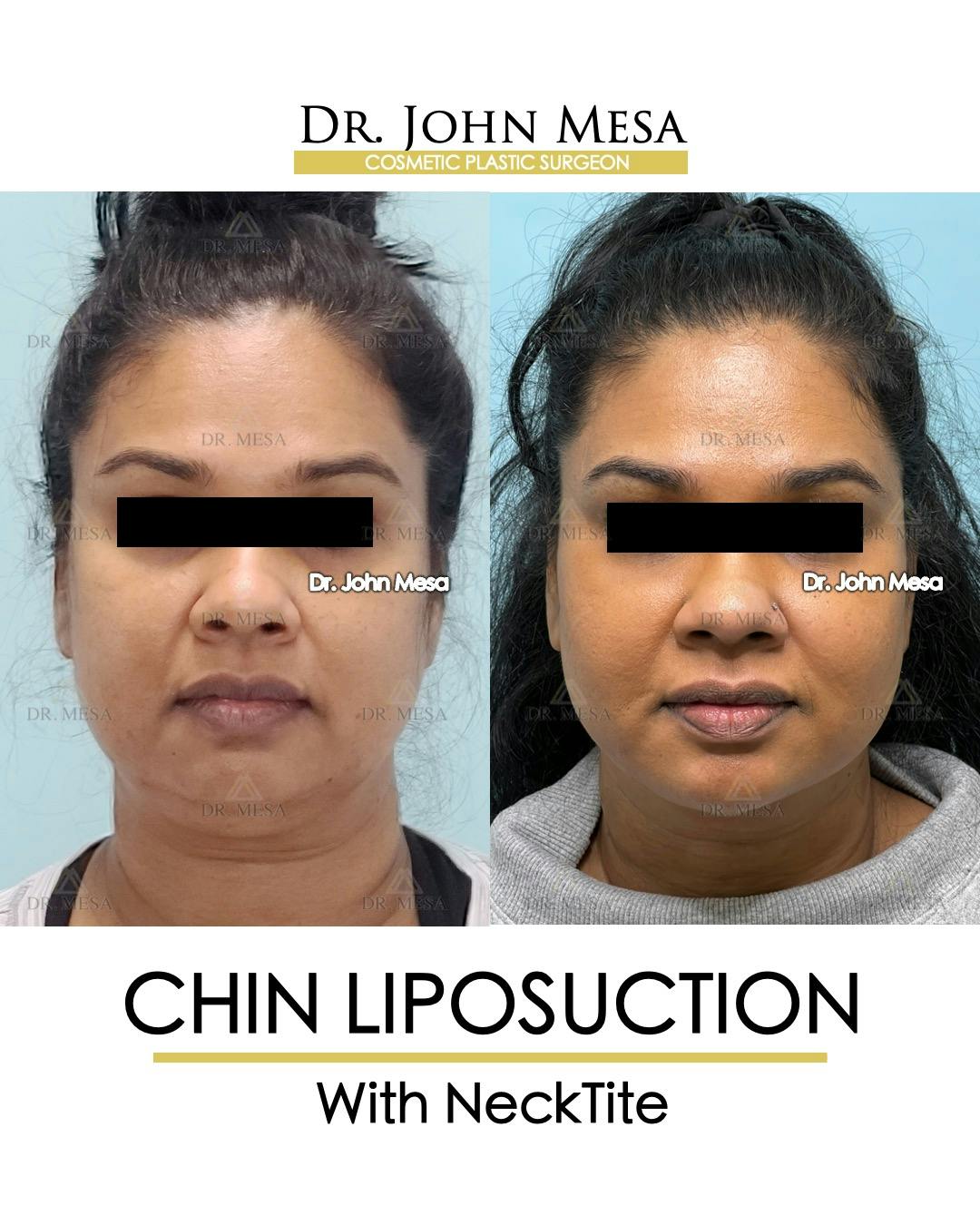Chin Liposuction Before & After Gallery - Patient 100188 - Image 1