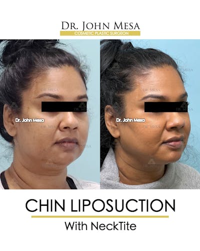 Chin Liposuction Before & After Gallery - Patient 100188 - Image 2
