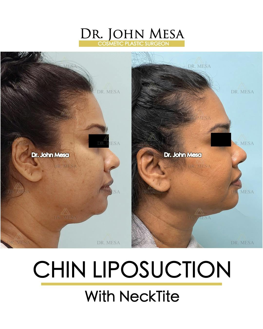 Chin Liposuction Before & After Gallery - Patient 100188 - Image 1