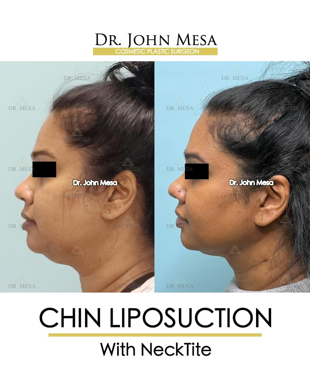 Chin Liposuction Before & After Gallery - Patient 100188 - Image 5