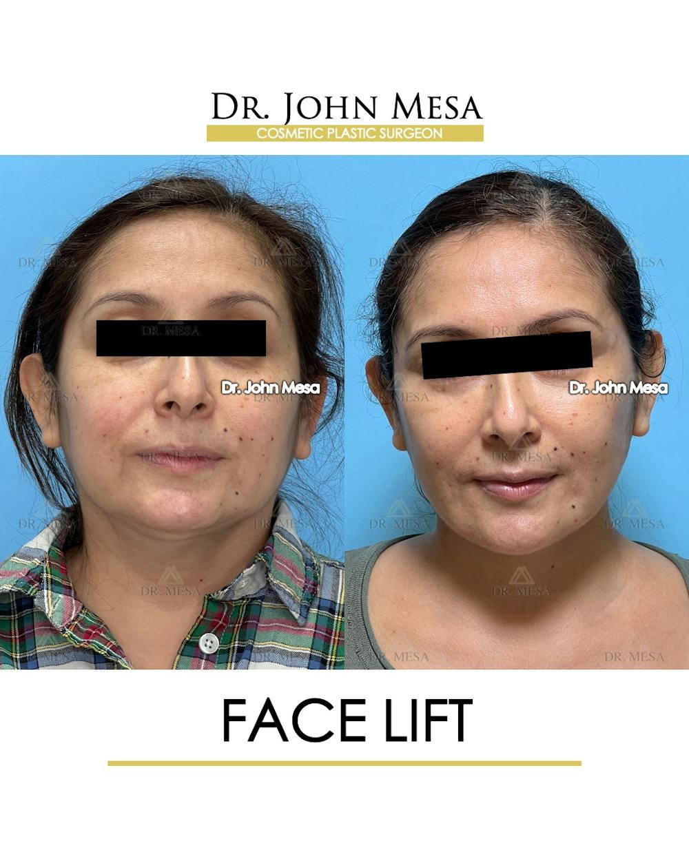 Facelift Before & After Gallery - Patient 385619 - Image 1