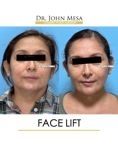 Facelift Before & After Gallery - Patient 385619 - Image 1