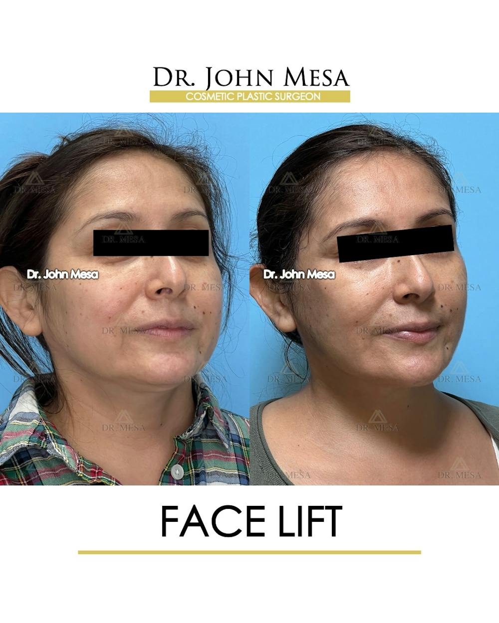 Facelift Before & After Gallery - Patient 385619 - Image 2