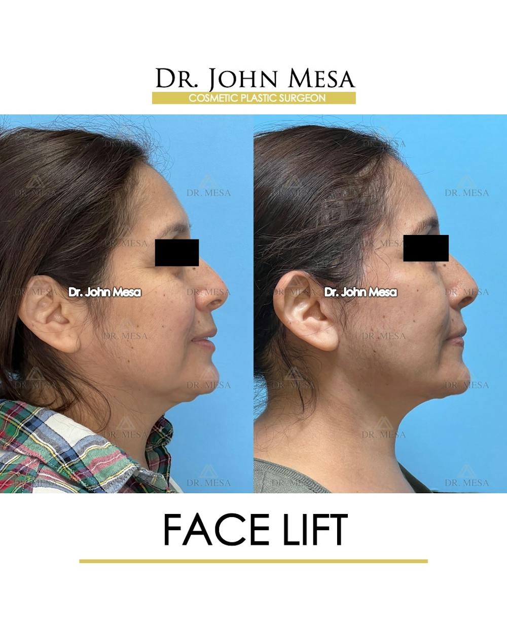Facelift Before & After Gallery - Patient 385619 - Image 3