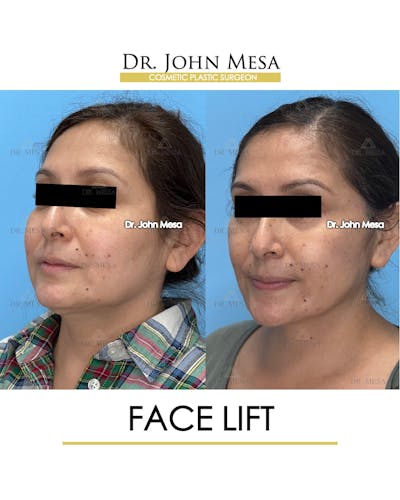 Facelift Before & After Gallery - Patient 385619 - Image 4