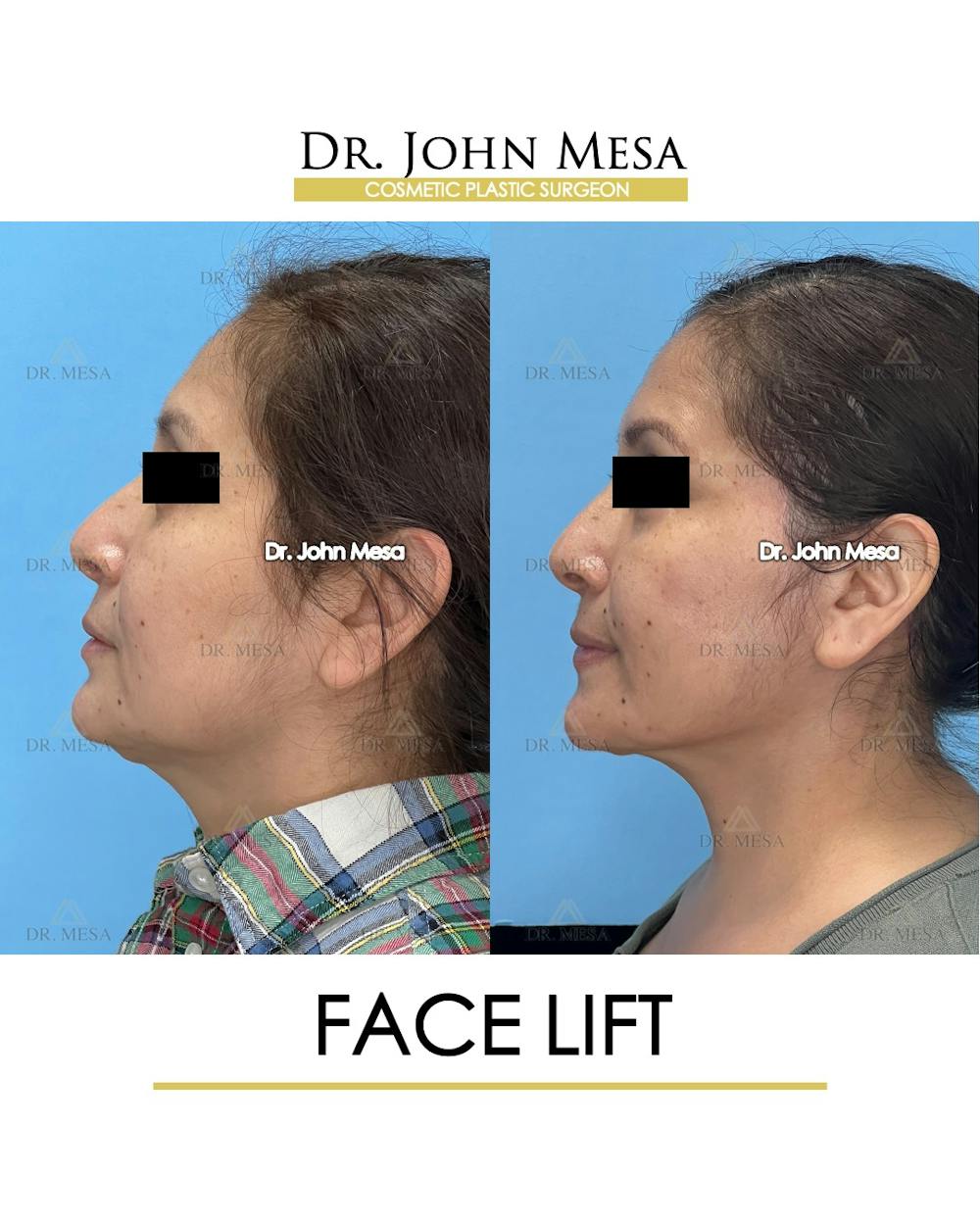 Facelift Before & After Gallery - Patient 385619 - Image 5